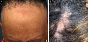 (A), Frontoparietal, eyebrow alopecia and facial papules in the frontal region (FFA). (B), Areas of multifocal alopecia in parietal region and vertex (LPP).
