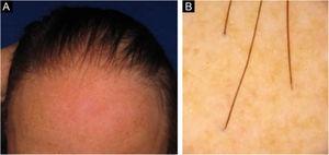 (A), Frontotemporal alopecia in a patient with FFA and absence of eyebrows. (B), Trichoscopy: mild peripilar desquamation and absence of follicular openings.
