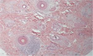 Histopathological: cross-sectionning (Hematoxylin & eosin, ×100) – Presence of perifollicular lymphocytic inflammatory infiltrate in the isthmus region and concentric eosinophilic fibrosis.