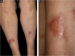 (A), Multiple, waxy brownish plaques on the bilateral shins with slightly elevated erythema at the periphery. (B), Close-up view.
