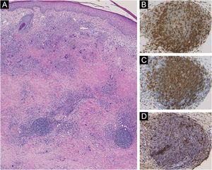 (A), Histological features showing horizontally arranged palisading histiocytes and multi-nucleated giant cells surrounding degenerated collagen in the dermis. Immunohistological examination showed that the lymphoid aggregates were positively stained for CD3 (B), CD20 (C), and pNAd (D).