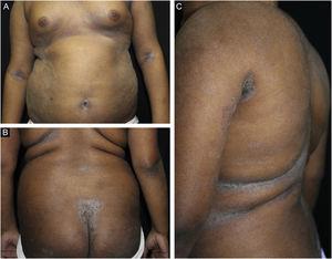 (A–C), Eczematous lesions on the trunk, antecubital fossae and intergluteal region, associated with diffuse xerosis.