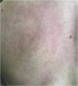 Several normochromic papules and erythema induced by physical activity.