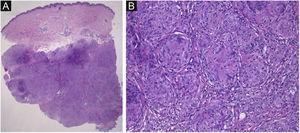 (A), Histological features showing dense localization of non-necrotizing epithelioid granulomas in the subcutaneous tissues. (Hematoxylin & eosin, ×12.5). (B), Higher magnification revealing granulomas with giant cells. (Hematoxilyn & eosin, ×200).