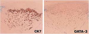 Immunohistochemical panel for metastatic breast carcinoma: positive for CK7 and GATA-3 markers.
