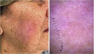(A), Image of the clinical resolution of LM on the face after 12 weeks of treatment with topical IQ 5%. (B), Dermoscopy of the treated region showing a whitish pink background with a post-inflammatory characteristic.