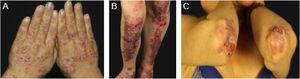 Mechanobullous epidermolysis bullosa acquisita (EBA). (A), Vesicles and bullae on the dorsum of the hands. (B), Erosions and hypertrophic scars on the knees and pretibial region. (C), Erosions and atrophic scars with milia on the elbows.