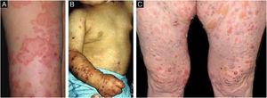 Inflammatory epidermolysis bullosa acquisita (EBA). (A), Circular and arcuate erythematous plaques with vesicles and bullae on the arm. (B), Childhood EBA. (C), Erythematoedematous papules and bullae on the thighs.