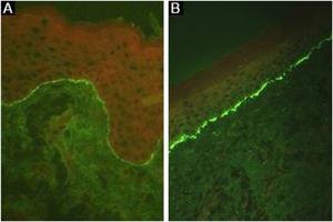 Direct immunofluorescence in epidermolysis bullosa acquisita. Intense and continuous linear fluorescence at the basement membrane zone with (A), anti-IgG and (B), anti-C3 (×400).
