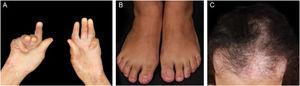 Complications on the skin and its adnexa in epidermolysis bullosa acquisita. (A), Atrophy of the palmar region with flexion contractures of the hands. (B), Anonychia. (C), Cicatricial alopecia.