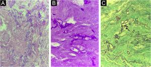Histopathological section of a surgical specimen from the patient with rhino-orbito-cerebral mucormycosis showing coenocytic hyphae at ×400 magnification. (A), Hematoxylin & eosin. (B), PAS staining. (C), Grocott Gomori staining.