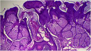 Hyperplasia of sebaceous glands localized close to the epidermis (Hematoxylin & eosin, ×40).