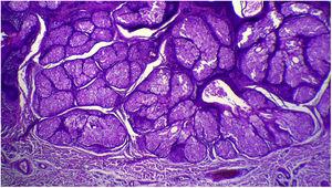 Detail of sebaceous glands hyperplasia (Hematoxylin & eosin, ×40).