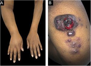 (A), Lymphedema in the right upper limb. (B), Tumor with ulcerated areas in the posterior region of the right arm, accompanied by satellite nodules.