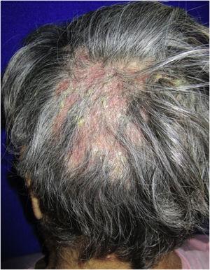 Erythematous pseudoalopecic plaques with pustules and yellow crusts involving 70% of the scalp.