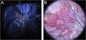 Ancillary diagnostic. (A), Wood’s lamp shows greenish fluorescence. (B), Trichoscopy features were comma hairs, broken hairs, black dots, perifollicular scaling, erythema, pustules and yellow crusts.