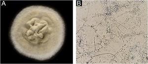 Trichophyton tonsurans. (A), Microbiological culture. (B), Thin and septate hyphae with chlamydoconidia and multiple conidia arranged in alternate ways and mirrored.