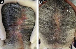 (A), View of the middle line of the scalp prior to treatment. (B), Hair regrowth post treatment with minimum scarring (arrow).