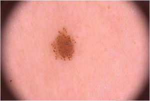 Small brownish papule on dermoscopy showing a typical globular pattern.