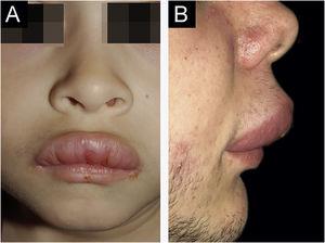 Clinical characteristics of cases 1 and 2. (A), Case 1 ‒ macrocheilia. (B), Case 2 ‒ macrocheilia.