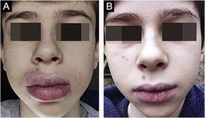 (A), Case 3 ‒ macrocheilia. (B), Same patient during treatment with dapsone: good response.