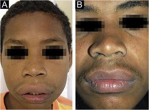 (A), Case 5 ‒ macrocheilia. (B), Same patient, as an adult after several surgical procedures.