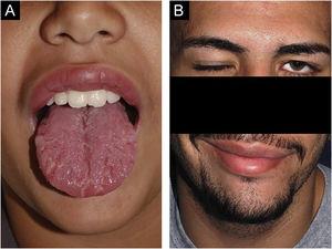 (A), Case 6 ‒ macrocheilia, geographic and fissured tongue. (B), Same patient at age 19 during a bout of facial palsy; the macrocheilia had already disappeared.