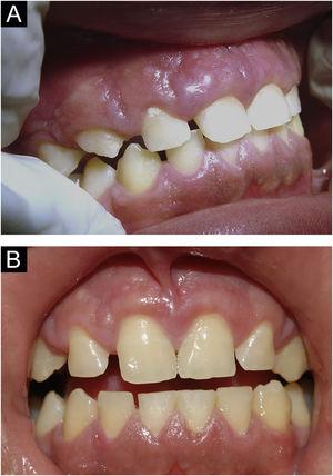 (A), Patient 4 ‒ granulomatous gingivitis.10 (B), Same patient after gingivoplasty.