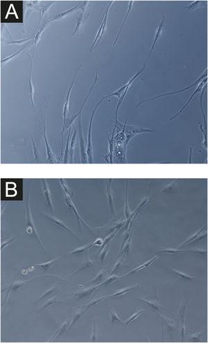 Phase-contrast microscopy showing fibroblasts from skin with facial melasma (A) and from adjacent healthy skin (B) in cell culture (SA-β-gal, ×400), showing lower cell density and less elongated (fusiform) wider morphology, in melasma.