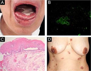 (A), Lesions on the oral mucosa: erosions on the tongue covered by a whitish pseudomembrane, erosions on the labial mucosa, erosions and crusts on the lower lip. (B), Direct immunofluorescence on oral Tzanck smear cytology: fluorescence with anti-IgG on the keratinocytes cell membrane. (C), Histopathology of the oral mucosa (Hematoxylin & eosin, ×40): acantholytic suprabasal bulla. (D), Skin lesions: erythematous plaques on the abdomen and chest with bullae, erosions and hematic crusts.