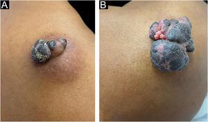 Pigmented eccrine poroma on the right shoulder. (A), Brownish tumor with infiltrated base, lobulated blackened areas, and crusted surface, at the first visit. (B), One year later, increase in tumor volume (5 × 4 cm), with a blackened, multilobulated appearance, and evident vegetative and exulcerated areas.