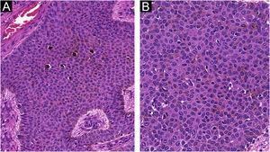 Pigmented eccrine poroma. (A), Area with evident intratumoral melanocytes (Hematoxylin & eosin, ×100). (B), Detail of the formation of incipient intracytoplasmic lumens inside the tumor (Hematoxylin & eosin, ×400).