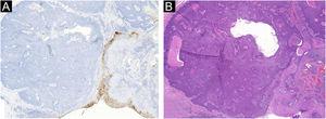 Pigmented eccrine poroma. (A), Negative immunostaining for polyclonal carcinoembryonic antigen (CEA). (B), Comparative image of the neoplasm (Hematoxylin & eosin, ×10).