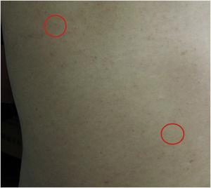 Clinical features at presentation. Two coin-sized subcutaneous nodules on the back (red circle), and the skin overlying the nodules was normal.