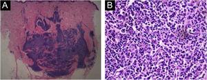 (A), lymphocytic nodular infiltrate with several reactive germinal centers extending into subcutaneous fat (Hematoxylin & eosin, ×10). (B), Some large, mildly irregular nucleus between the follicles (Hematoxylin & eosin, ×400).
