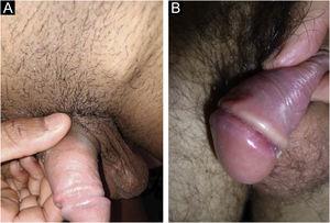 (A), Regional lymphadenopathy accompanies cases of hard chancre. They comprise multiple lymph nodes with a larger one: the “mayor node”. (B), Cord-like lesions may mimic Mondor's disease or transient lymphangiectasia of the penis.