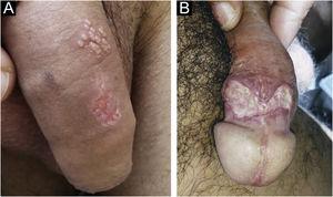 (A), Herpes simplex in subentrant outbreaks: grouped vesicles on an erythematous base and a superficial ulcer undergoing healing with a polycyclic edge. (B), Deeper ulcer with a fibrinoid bottom and undermined edge.
