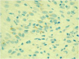 Immunohistochemical examination positive for Treponema pallidum (×630).