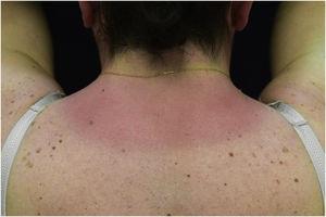 Erythematous rash located in photo-exposed areas: neck.