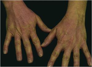 Erythematous rash located in photo-exposed areas: back on hands.
