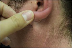 Erythematous rash located in photo-exposed areas: earlobe fold is respected.