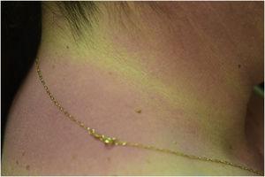 Erythematous rash located in photo-exposed areas: choker area is respected.