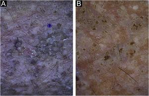 Dermatoscopic examination (×10). (A), Before acitretin treatment, multiple confluent big comedo-like openings with a central hyperkeratotic structure surrounded by a whitish scaling halo are seen in the legs. (B), After acitretin treatment, white shiny clods (of different size) and crust are found in the skin.