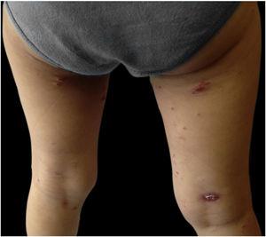 Erythematoviolaceous papules and nodules with slight desquamation on the lower limbs, one of them with spontaneous ulceration (right thigh).
