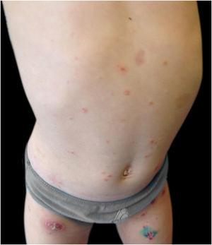 Erythematoviolaceous papules and nodules with slight desquamation on the abdomen and lower limbs.