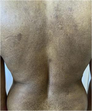 Hyperchromic plaques with ichthyosiform desquamation on the posterior trunk region.