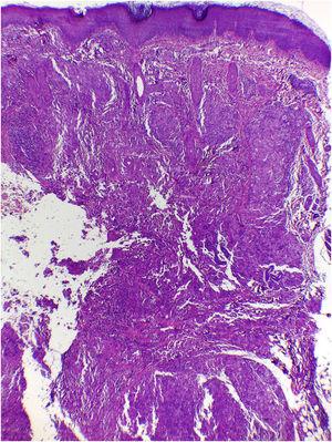 Hashimoto-Pritzker histiocytosis – histopathological view: dense dermal-hypodermal infiltration of histiocytoid cells (Hematoxylin & eosin, ×40).
