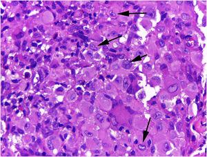 Hashimoto-Pritzker histiocytosis ‒ high magnification reveals cells with abundant eosinophilic cytoplasm and clear ovoid, or kidney shaped (arrows) nuclei (Hematoxylin & eosin, ×400).