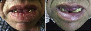 (A) The lower lip shows a diffuse xerotic erythematous plaque with erosions and hemorrhagic crusts. (B) Clinical improvement after 7-days of treatment with oral prednisone.