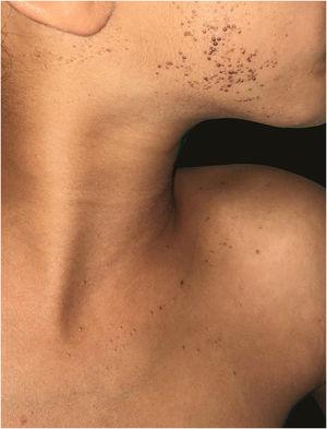 Hyperpigmented unilateral linear papular lesions; some are verrucous, on the face and neck..